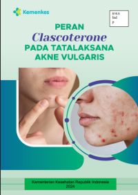Image of Peran clascoterone pada tatalaksana akne vulgaris